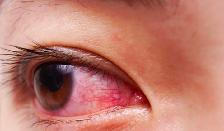 Bệnh đau mắt đỏ lây lan ở Hà Nội