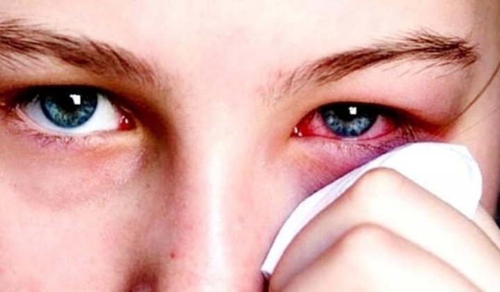 Đau Mắt Đỏ Lây Qua Đường Nào? Nhìn mắt người bệnh có bị lây không?