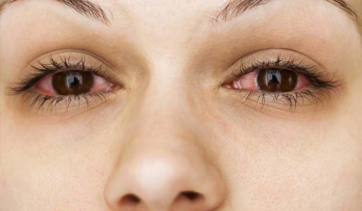Bị dị ứng ở mắt: Dấu hiệu, nguyên nhân, cách điều trị
