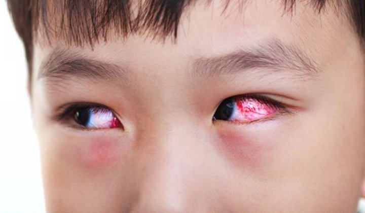 Top 4 cách điều trị đau mắt đỏ ở trẻ em, làm gì để phòng bệnh?