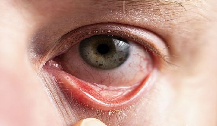 Dấu hiệu viêm kết mạc dị ứng, 2 biến chứng về mắt gây nguy hiểm