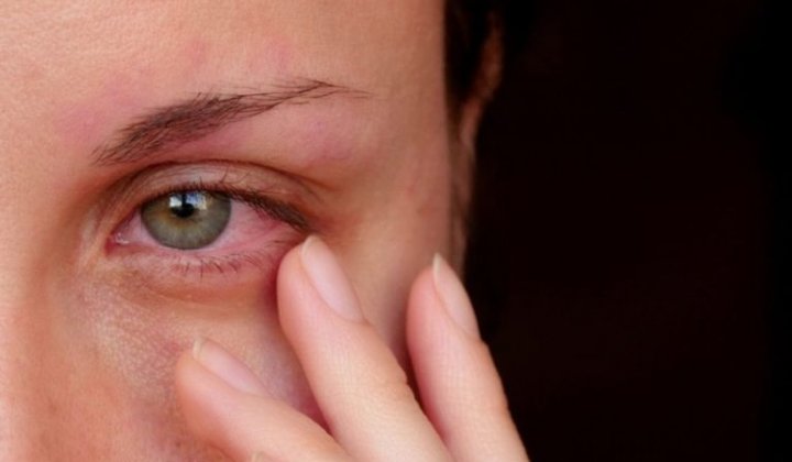 Mắt bị mờ sau khi đau mắt đỏ: Nguyên nhân, cách trị dứt điểm