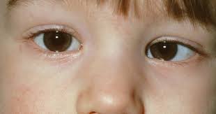 Trẻ em có mổ lác mắt được không? Giải đáp thông tin từ A đến Z
