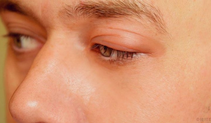 Sưng mí mắt trên và đau: Nguyên nhân, điều trị