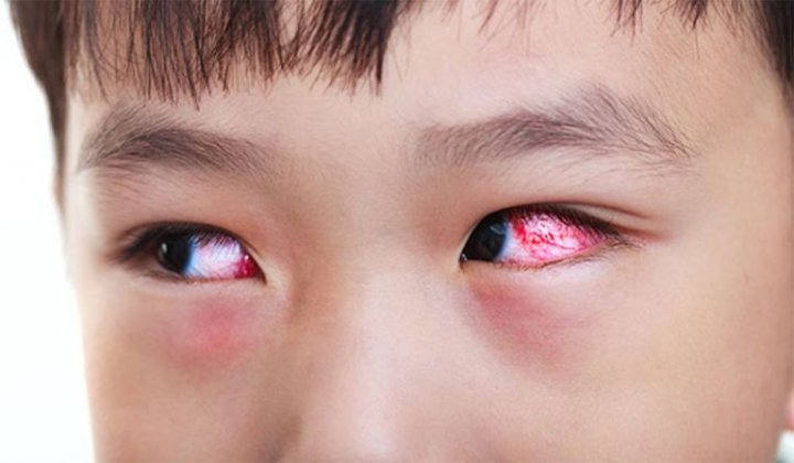 Hiện tượng đau mắt đỏ ở trẻ em 1 tuổi, 2 tuổi, 3 tuổi, 4 tuổi,...