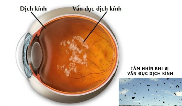 Vẩn đục dịch kính do cận thị và phẫu thuật mổ cận?