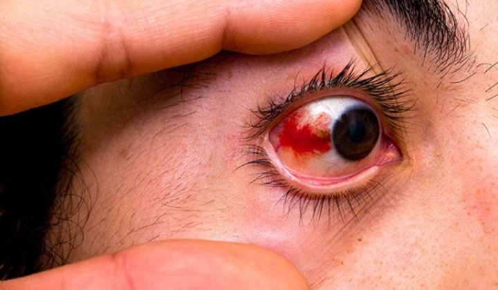 Bệnh võng mạc tăng huyết áp ảnh hưởng đến mắt như thế nào?