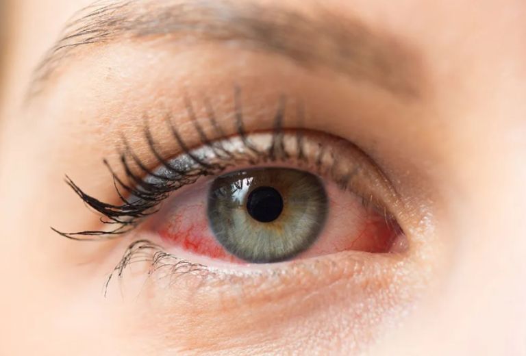 biện pháp giúp bà bầu ngăn ngừa đau mắt đỏ