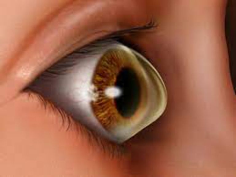 Điều kiện để mổ mắt chữa cận thị