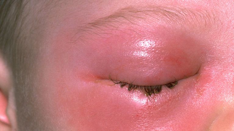viêm mô tế bào hốc mắt