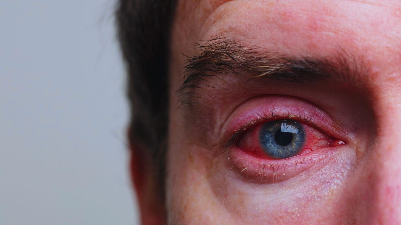 Đau mắt đỏ (vi&ecirc;m kết mạc)