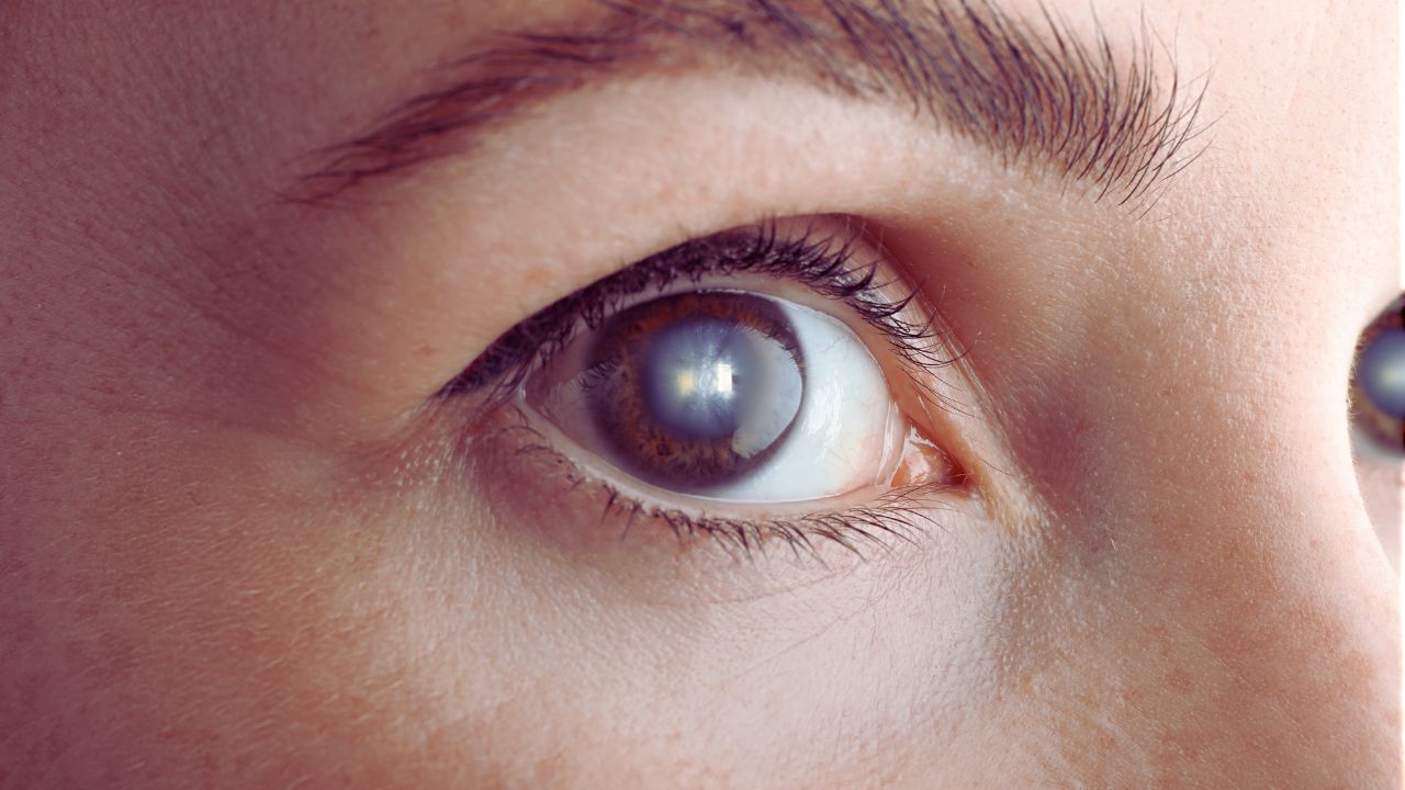 Đục thủy tinh thể