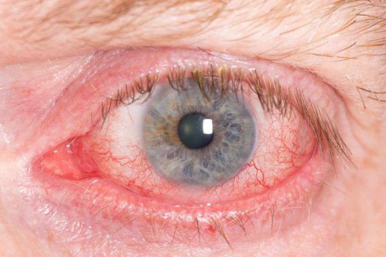 đau mắt đỏ lâu ngày không khỏi
