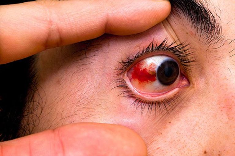 Đau mắt đỏ bao lâu thì khỏi?