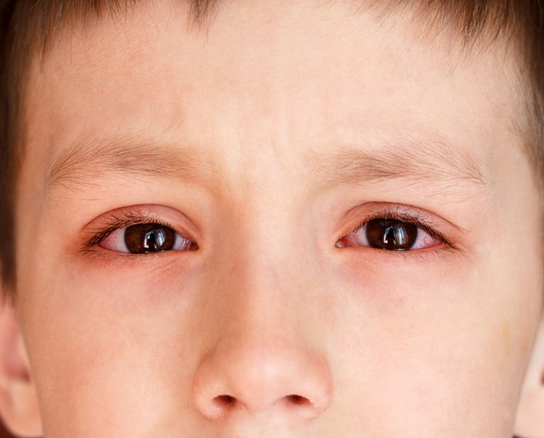 đau mắt đỏ kéo dài trong bao lâu?