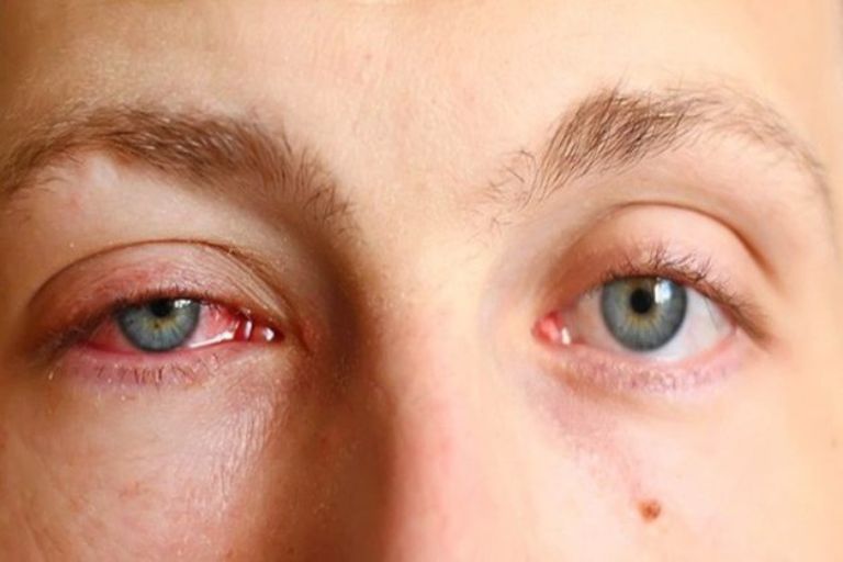 đường lây đau mắt đỏ qua đường hô hấp 
