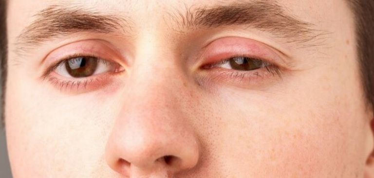 triệu chứng sưng húp mắt khi đau mắt đỏ