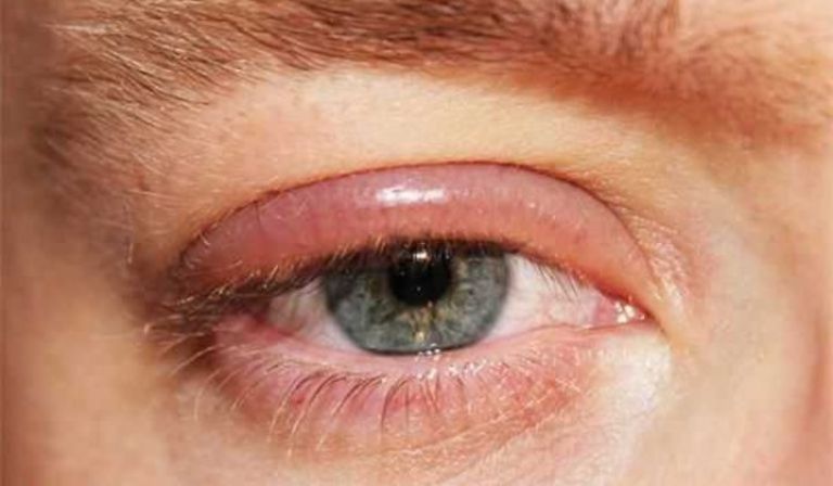 đau mắt đỏ để lại hậu quả gì?