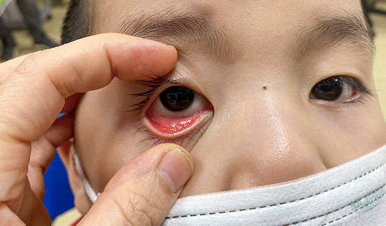 chẩn đoán khô mắt