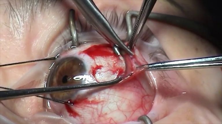 Phẫu thuật để chỉnh lại cơ vận động mắt