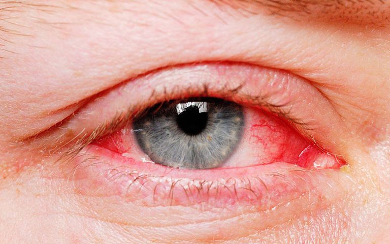 tình trạng xuất hiện gân đỏ ở mắt có nguy hiểm không?