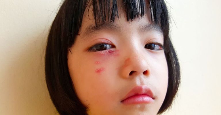 Trẻ bị muỗi đốt sưng mắt có nguy hiểm không?