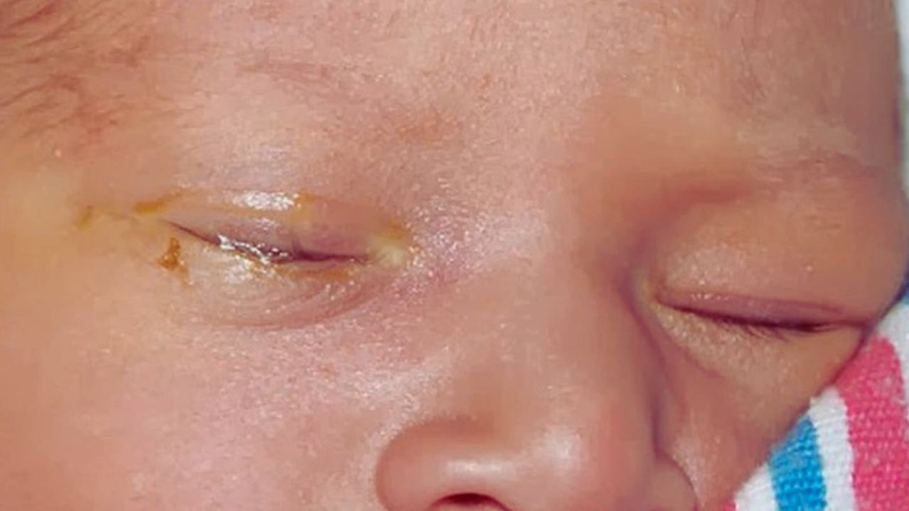 Nhiều gỉ mắt l&agrave; dấu hiệu của bệnh g&igrave;? C&oacute; nguy hiểm kh&ocirc;ng?