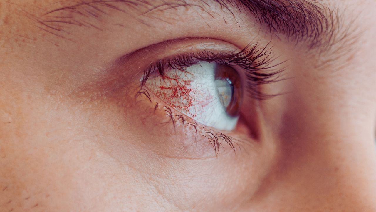 Những bệnh c&oacute; thể gặp phải khi nhiều gỉ mắt