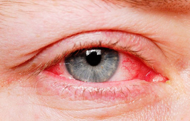 Bệnh viêm kết mạc mắt