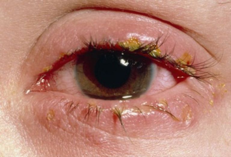 viêm túi lệ là biến chứng nhức mắt do viêm xoang