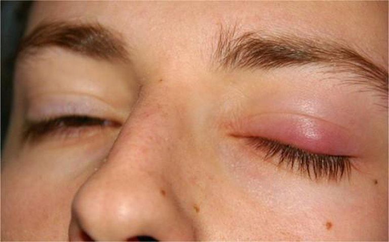 vùng da quanh mắt bị nhiễm trùng