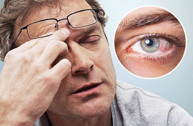 Cách dùng thuốc nhỏ mắt cho mắt cận