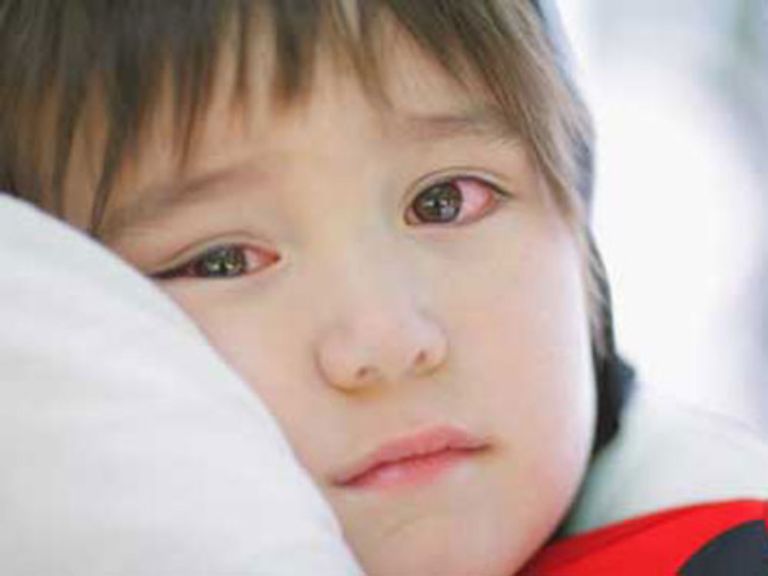 trẻ bị đau mắt đỏ kiêng ăn gì?
