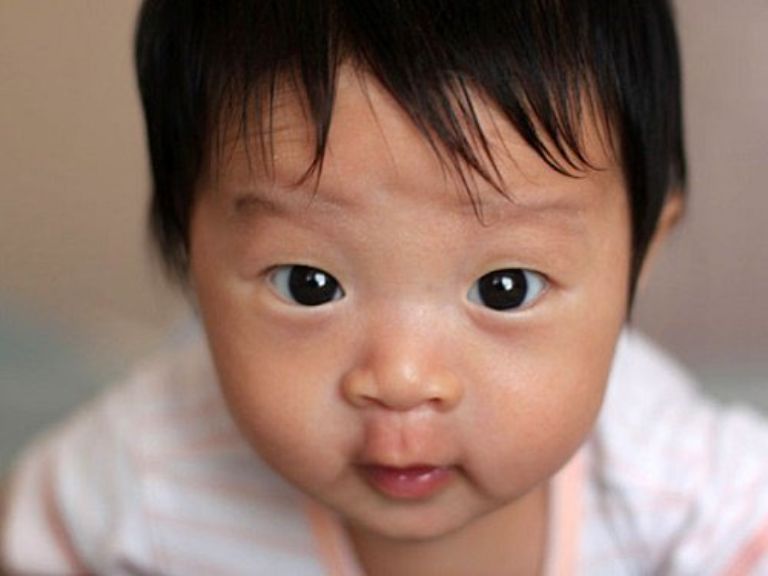 Mắt lác ở trẻ sơ sinh có chữa được không?