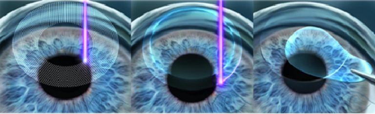 Mổ mắt viễn thị cần đạt những điều kiện gì?