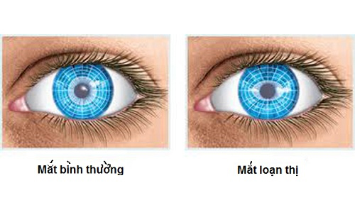 Bệnh loạn thị sẽ làm giảm thị lực của mắt về lâu dài