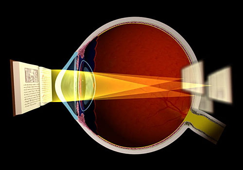 Tầm nhìn của mắt loạn thị sẽ bị nhân đôi, nhìn một vật có thể xuất hiện 2 – 3 bóng mờ